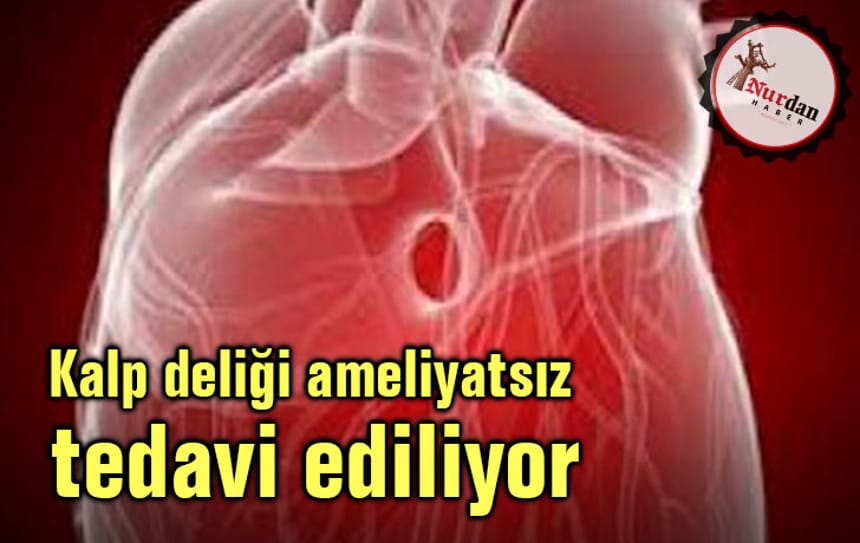 Kalp deliği ameliyatsız tedavi ediliyor