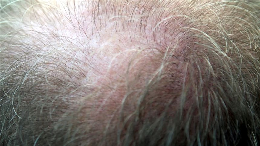 Saç dökülmesinin üç aydan uzun sürmesi hastalık habercisi